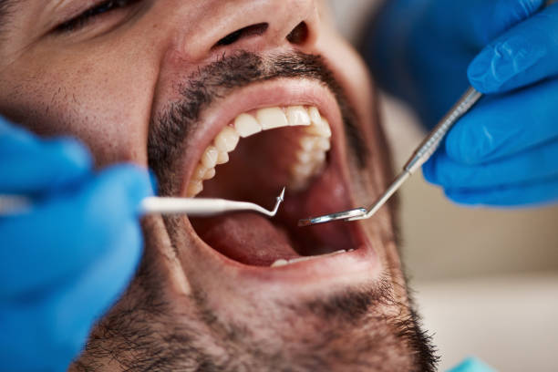 Best Emergency Dentist for Lost Fillings or Crowns in Mount Gilead, NC