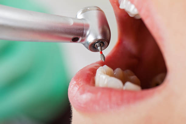 Best Emergency Root Canal Treatment in Mount Gilead, NC